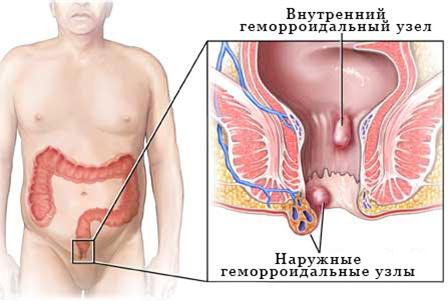 геморрой без операции